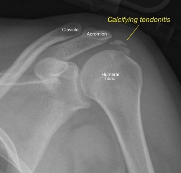 radiograph-shows-an-area-of-calcifying-tendonitis.jpg